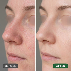 Before and after using NaturaDerm Tea Tree Relief Soap